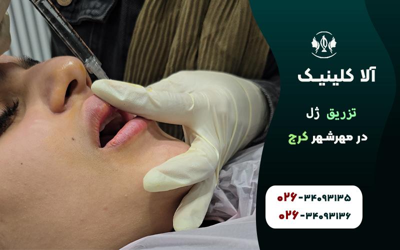 تزریق ژل در مهرشهر کرج