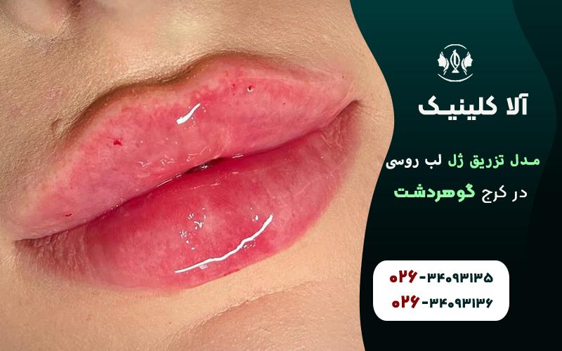 تزریق ژل لب مدل روسی