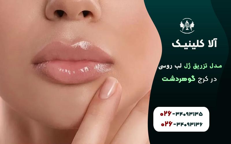 تزریق ژل لب مدل روسی