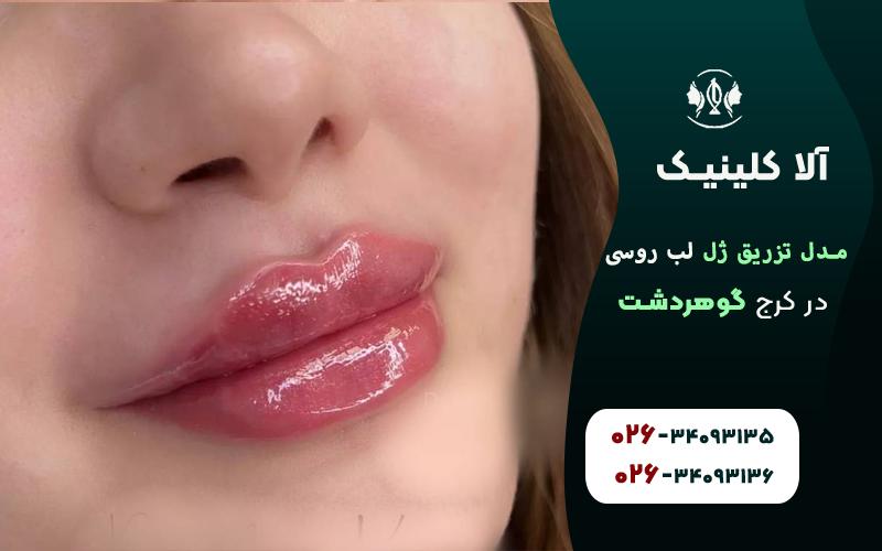 تزریق ژل لب مدل روسی