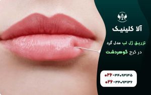تزریق ژل لب مدل گرد
