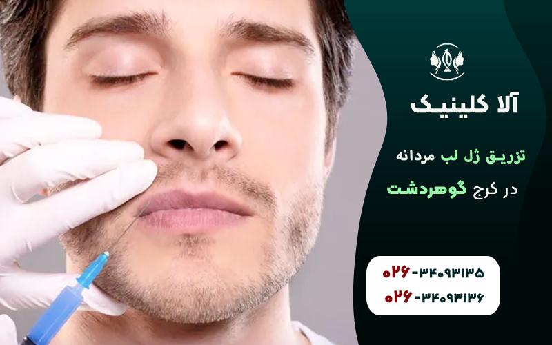 تزریق ژل لب مردانه کرج