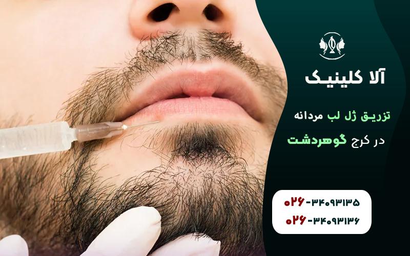 تزریق ژل لب مردانه کرج