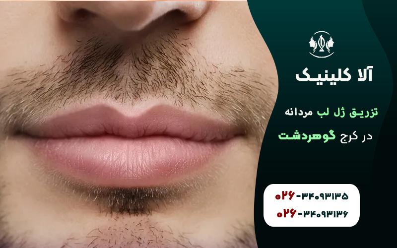 تزریق ژل لب مردانه کرج