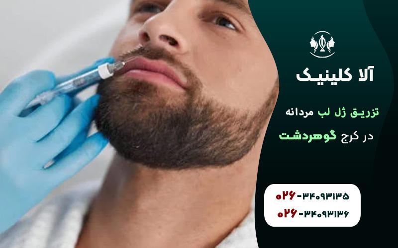 تزریق ژل لب مردانه کرج