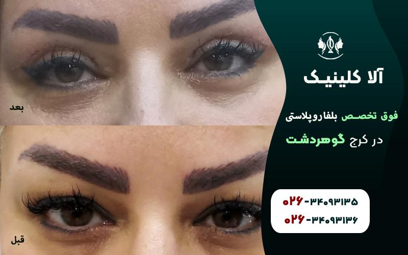 فوق تخصص بلفاروپلاستی در کرج