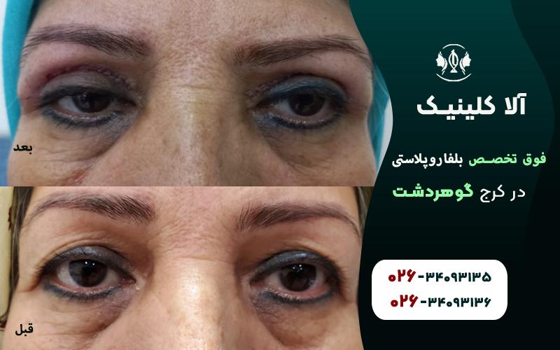 فوق تخصص بلفاروپلاستی در کرج