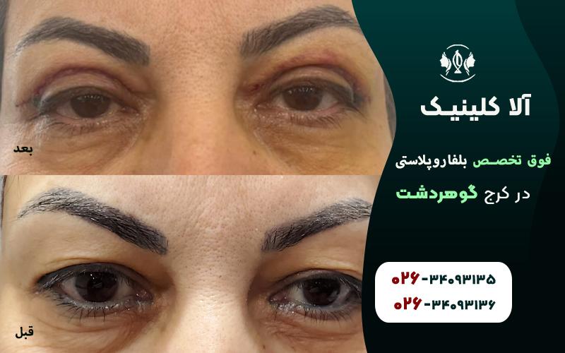 عمل جراحی پلک قبل و بعد