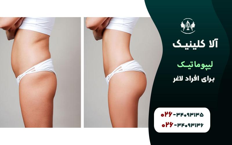 لیپوماتیک برای افراد لاغر