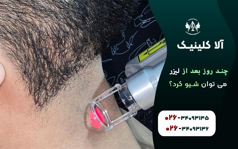 چندروز بعد از لیزر می توان شیو کرد