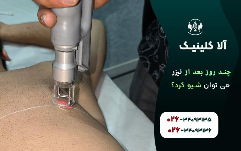 چندروز بعد از لیزر می توان شیو کرد