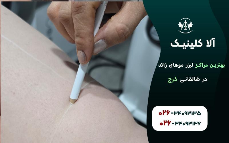 مراکز لیزر موهای زائد در طالقانی کرج