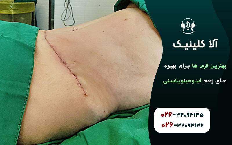 بهترین کرم ها برای بهبود جای زخم ابدومینوپلاستی