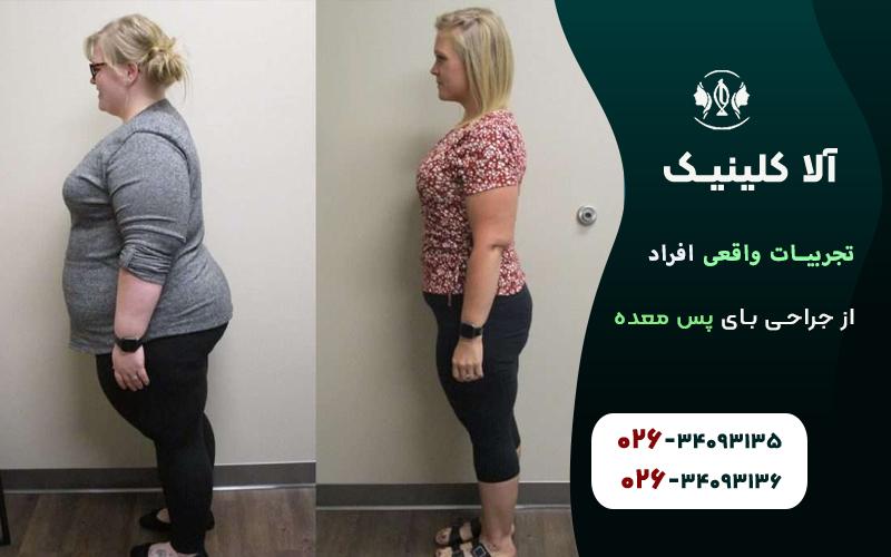 تجربیات واقعی افراد از عمل بای پس معده