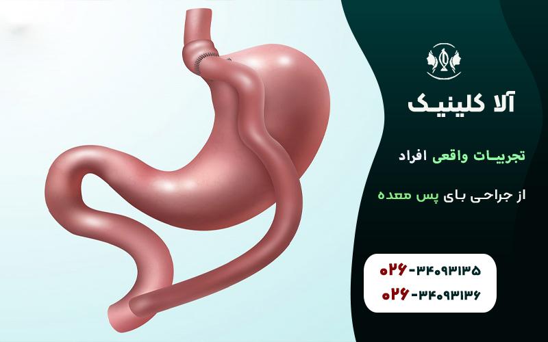 تجربیات واقعی افراد از عمل بای پس معده