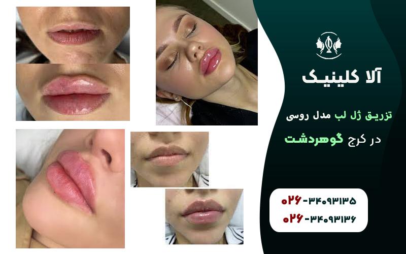 تزریق ژل لب مدل روسی در گوهردشت کرج