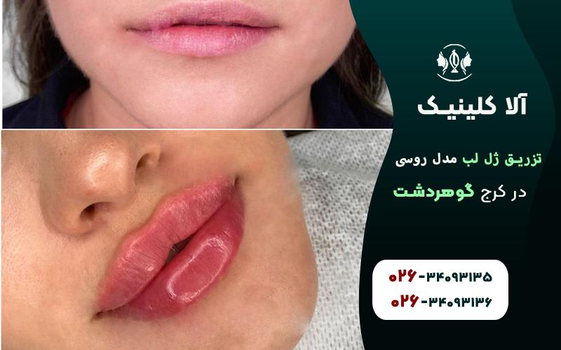 تزریق ژل لب مدل روسی گوهردشت کرج