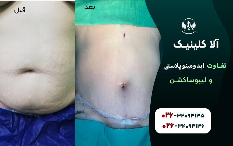 تفاوت ابدومینوپلاستی و لیپوساکشن