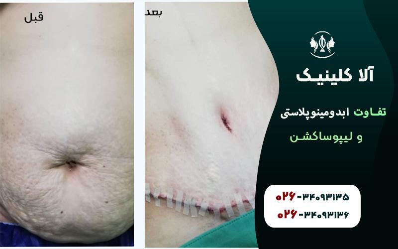 لیپوساکشن قبل و بعد