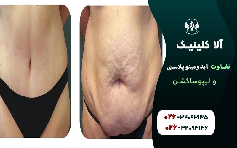 ابدومینوپلاستی قبل و بعد