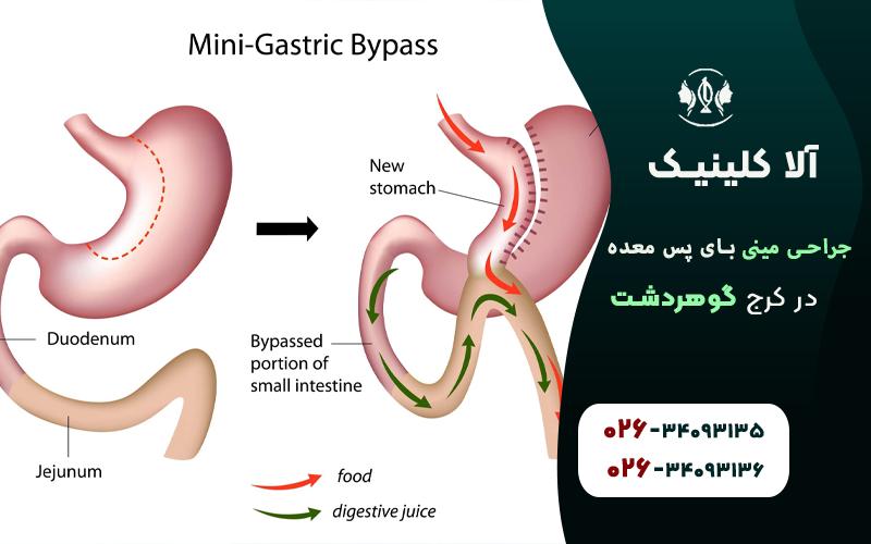 جراحی مینی بای پس معده در کرج