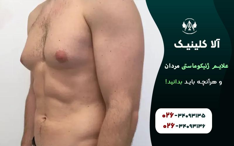 علائم ژنیکوماستی مردان و هرآنچه باید بدانید