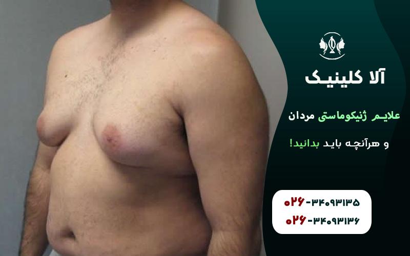 علائم ژنیکوماستی مردان و هرآنچه باید بدانید