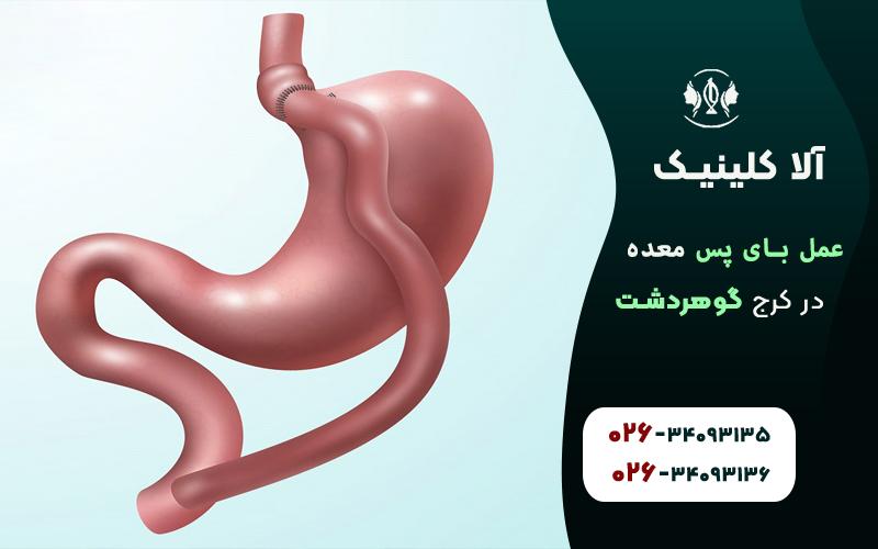 عمل بای پس معده در کرج