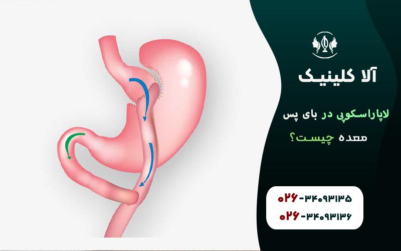 لاپاراسکپی در بای پس معده چیست