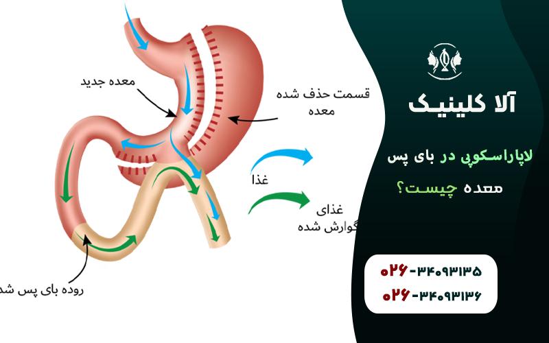 لاپاراسکپی در بای پس معده چیست
