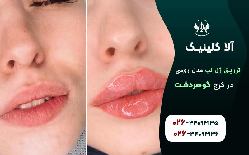 مدل های ژل لب روسی