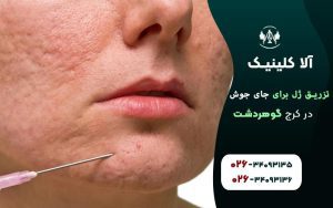 تزریق ژل برای جای جوش