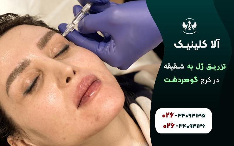 تزریق ژل به شقیقه