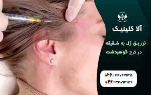 تزریق ژل به شقیقه