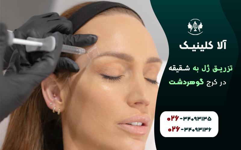 تزریق ژل به شقیقه