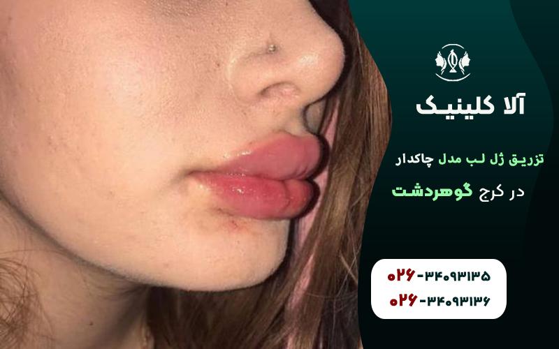 تزریق ژل لب مدل چاکدار در کرج