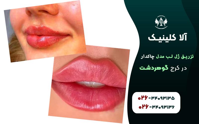تزریق ژل لب مدل چاکدار در گوهردشت کرج