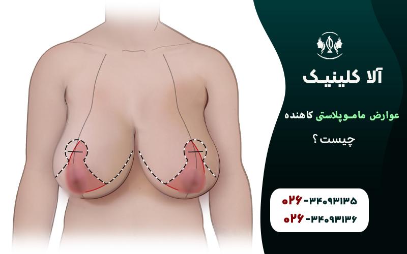 عوارض مامو پلاستی کاهنده چیست