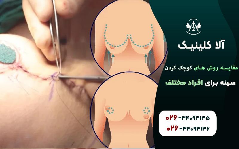 مقایسه روش های کوچک کردن سینه برای افراد مختلف