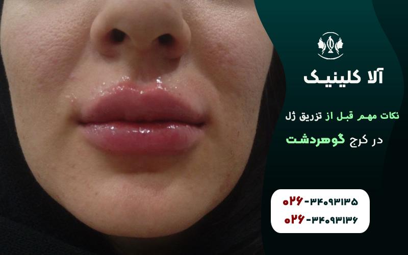 نکات مهم قبل از تزریق ژل که باید بدانید