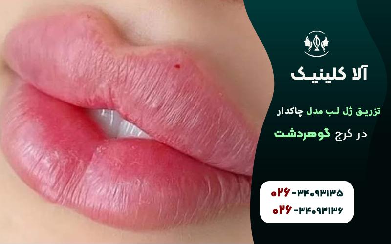 ژل لب مدل چاکدار در کرج