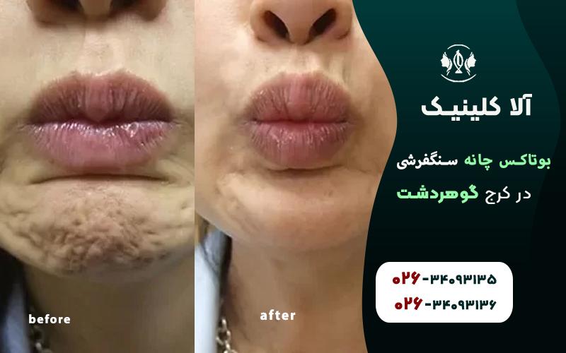 بوتاکس چانه سنگفرشی قبل و بعد از تزریق