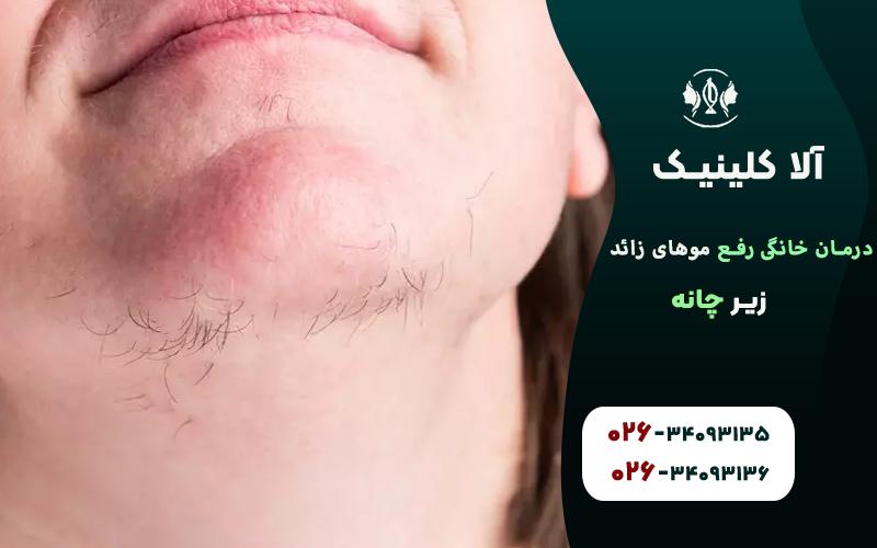 درمان خانگي رفع موهاي زائد چانه