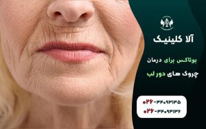بوتاکس برای درمان چروکهای دور لب