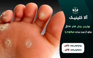 بهترین روش های خانگی برای از بین بردن میخچه پا