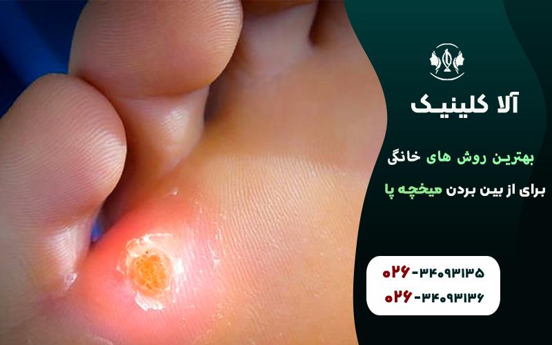 بهترین روش های خانگی برای از بین بردن میخچه پا