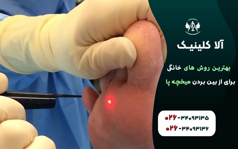از بین بردن میخچه پا با لیزر