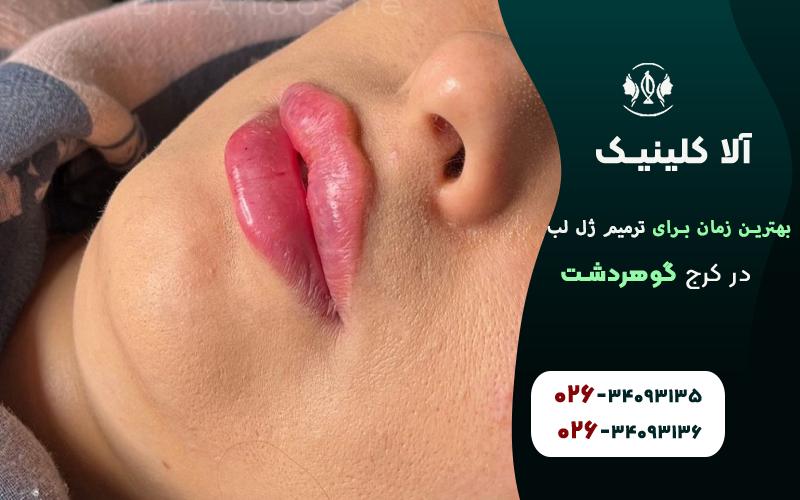 بهترین زمان برای تزریق ژل لب