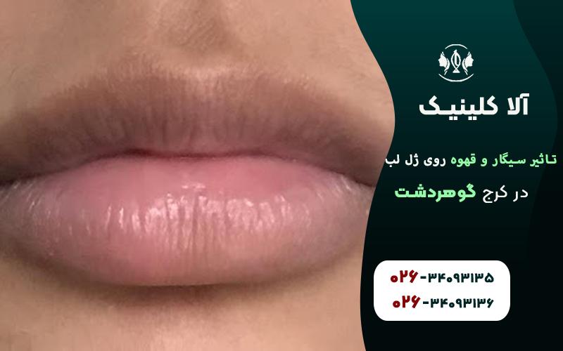 تاثیر سیگار و قهوه روی ژل لب