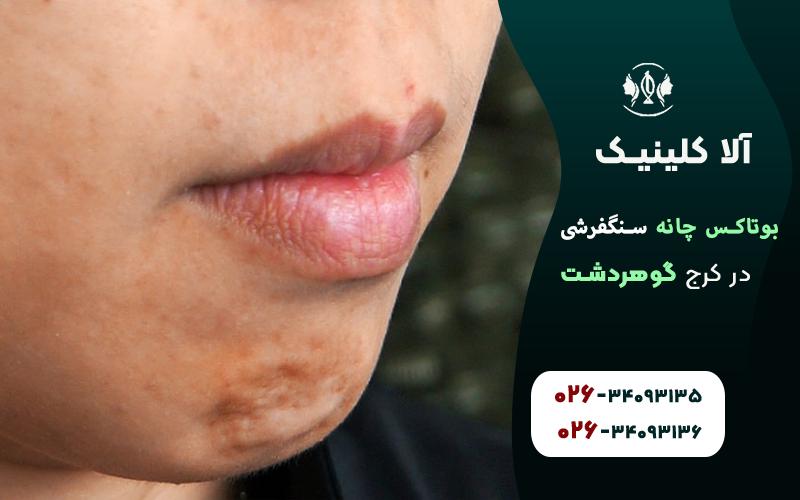 بوتاکس چانه سنگفرشی